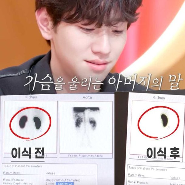 신장 한쪽 사라진 'X-ray사진' 먹먹…남윤수, 父위한 '수술흉터'도 공개 ('편스토랑')