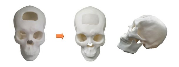 시지바이오 3D 프린팅 환자 맞춤형 특수재질두개골성형재료 품목 허가 획득 네이트 뉴스