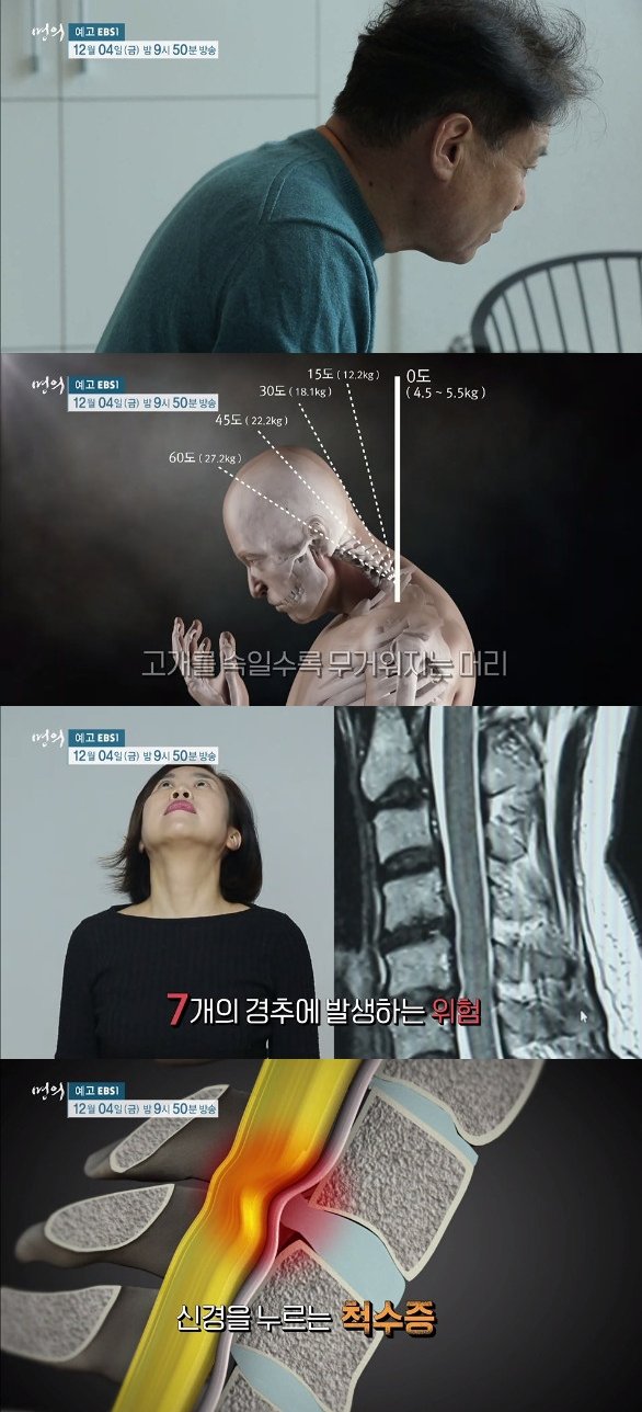 명의' 경추 척수증, 목디스크와 구분 방법…원인 및 치료법은? : 네이트뉴스