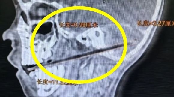 Through the Skull: 6-Year-Old's Candy-Fueled Fall Penetrates Brain - News Directory 3