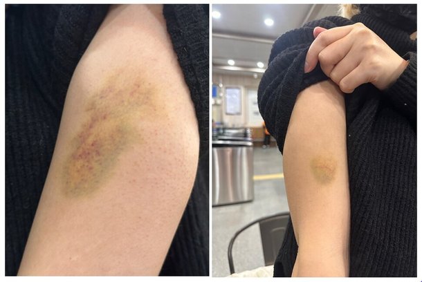대만 국적 여성 ㄱ씨는 지난 4일 새벽 한국인 전 남자친구에게 양쪽 팔과 머리, 복부 등을 폭행당했다. 지난 12일 ㄱ씨의 양쪽 팔에 멍이 들어 있는 모습. 김영원 기자