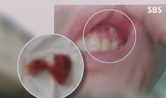 3일 경찰 등에 따르면 충남 천안의 한 대학병원에서 치과 수술을 받은 환자가 자신의 잇몸에서 뒤늦게 거즈를 발견했다. 피해 환자는 지난달 31일 수술을 집도한 대학병원 교수를 고소했다. 사진 SBS 방송 캡처