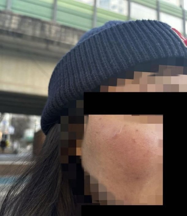 서울 동대문구의 대학가 인근에서 한 외국인 유학생이 모르는 남성에게 얼굴을 맞았다는 신고가 접수돼 경찰이 용의자 추적에 나섰다. 뉴시스