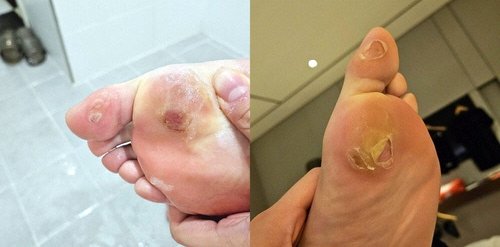 Ahn Se-young's blistered foot photograph