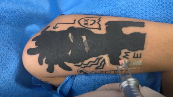 문신 지워주는 영수쌤 채널에 올라온 문신 제거 시술