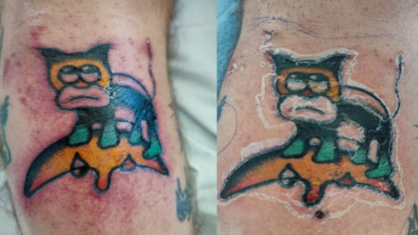29-Year-Old Man Suffers Organ Damage from Toxic Shock Syndrome Days After Getting a Tattoo