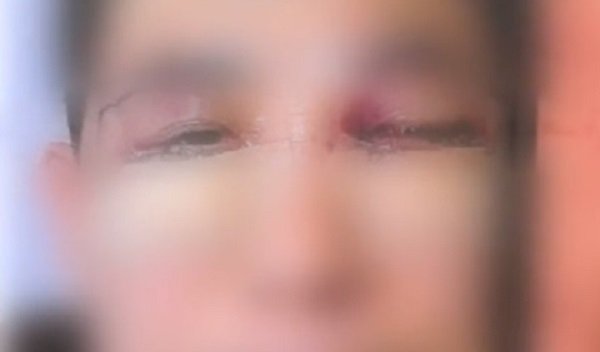 서울 강남 유명 성형외과에서 수술받은 뒤 한쪽 시력을 잃은 50대 환자. JTBC 보도화면 캡처