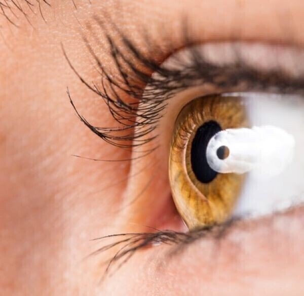 Allergy & Keratoconus Risk: New Research Findings