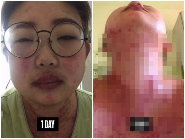 &apos;55kg 감량&apos; 최준희 루프스 부작용, 컵라면 6개+삼각김밥 미친 듯이 먹어