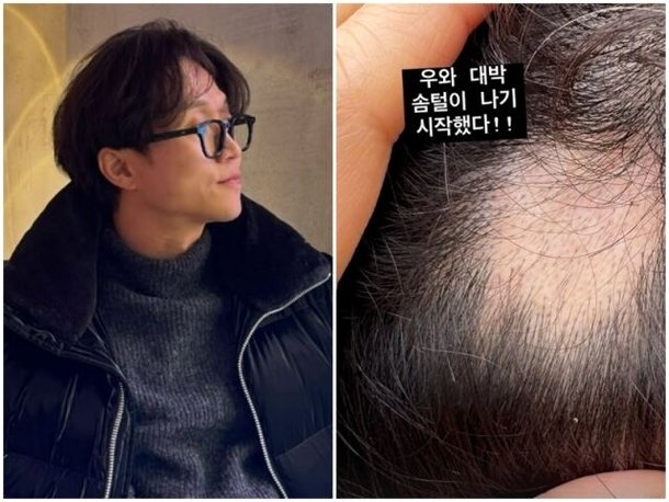 &apos;원형탈모&apos; 박성광 경사났네, 머리에 이거 나기 시작했다