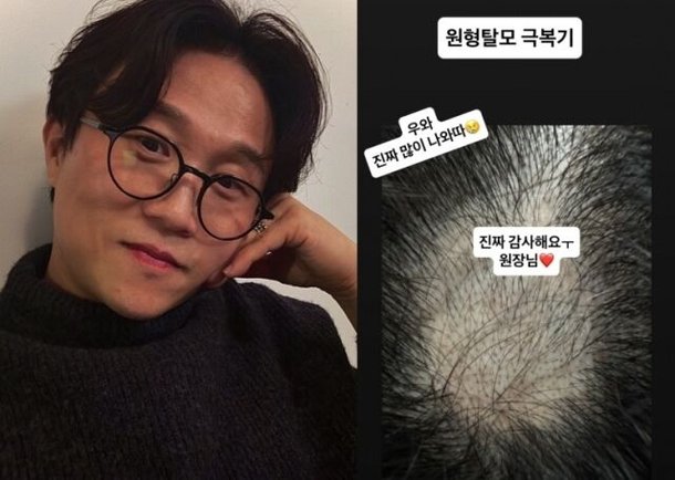 &apos;이솔이♥&apos; 박성광, 영화 실패 후 탈모 고백…이젠 머리 많이 났어요 [MD★스타]