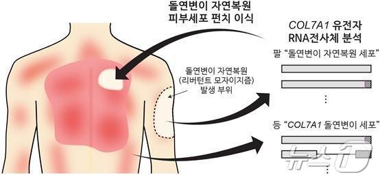 가벼운 마찰에도 상처·수포 희귀질환…국내의료진, 치료법 찾았다