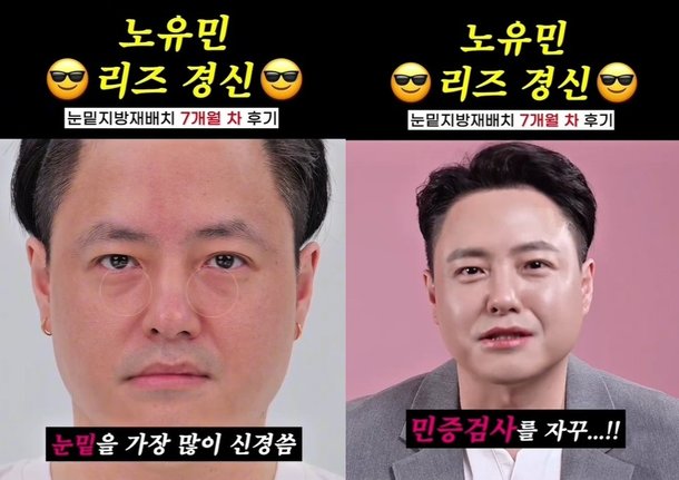 44세 노유민 요즘 민증 검사받아…머리 심고 &apos;눈밑지방 재배치&apos; 시술 근황