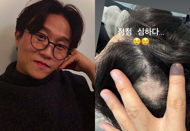 박성광, 심각한 원형탈모 상태…♥이솔이 암투병에 맘고생 컸나