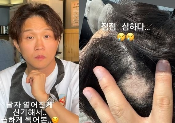 &apos;이솔이♥&apos; 박성광 외모 극단적 변화, 심각 원형탈모→팔자주름은 팽팽