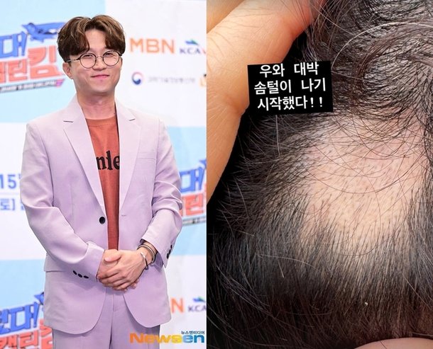 &apos;이솔이♥&apos; 박성광, 원형탈모 치료 중 기적적 근황 솜털 나기 시작했다