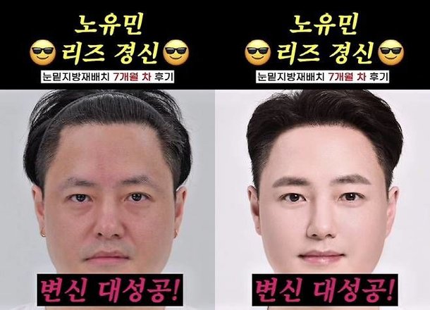 노유민, 눈 밑 &apos;지방 재배치&apos; 리즈 경신 민증 검사 받아