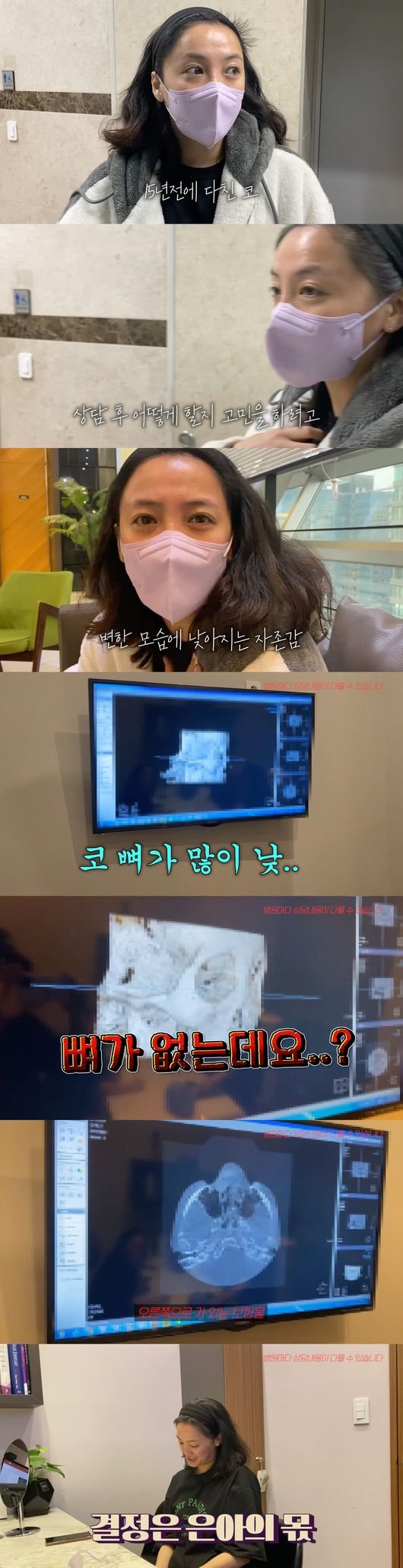 고은아 사고로 코 휘고 함몰…모발이식 이어 코 성형 고민(방가네)[종합] : 네이트 연예