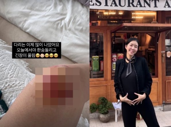 &apos;쌍둥이 임신&apos; 김지혜, 낙상 사고 심했네…피멍 가득한 무릎에 깜짝 많이 나았어요
