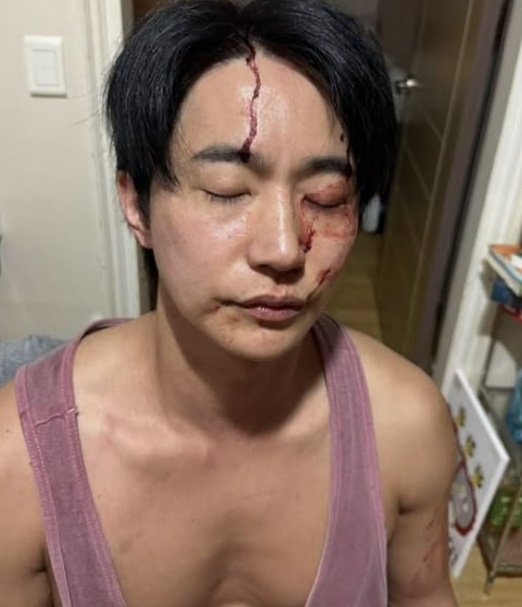 전호준, &apos;피범벅 얼굴&apos; 증거 공개 vs 전여친 폭행 성병 갈취 유산까지 폭로 [종합]