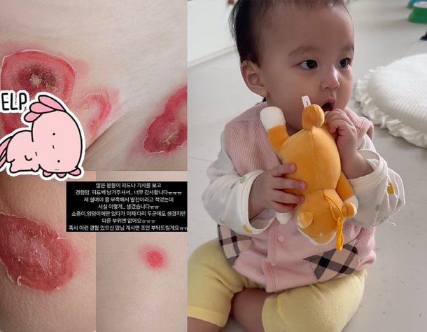이지훈♥아야네 8개월 딸, 피부병 더 번져 억장 와르르…누가 옮겼을까 [종합]