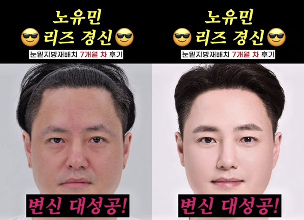 노유민, 커피 팔아 건물주 되더니…눈밑지방+탈모 시술로 리즈 갱신
