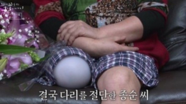 구급차 막은 차량들 때문에…종순 씨, 결국 &apos;다리 절단&apos; 수술 받았다 (&apos;꼬꼬무&apos;)