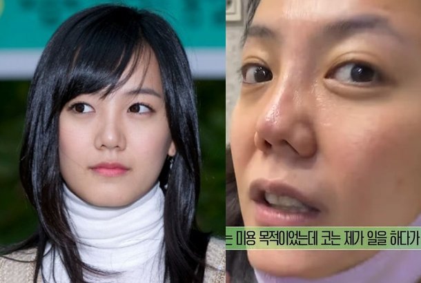 고은아, 심각한 코 상태 공개…성형 전후→모발이식 후 근황 : 네이트 연예 고은아, 심각한 코 상태 공개…성형 전후→모발이식 후 근황 : 네이트 연예