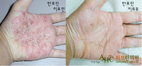 가려운 피부 물집