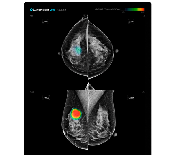 Qatar adopts Lunit's AI solution for breast cancer screening project ...