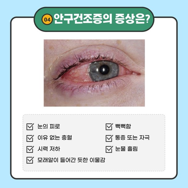 [카드뉴스] 안구건조증 관리하는 올바른 인공눈물 사용법 : 네이트 뉴스
