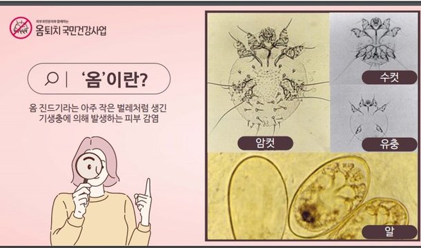 60~70년대 유행하던 '옴 진드기' 감염병…지금 유행한다고? [weekend 헬스] : 네이트 뉴스