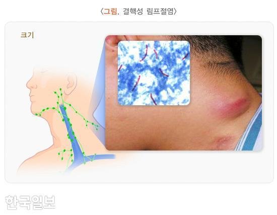 목에 생긴 멍울, 감기 탓인 줄 알았는데…이럴 땐 정밀 검사 필요 : 네이트 뉴스