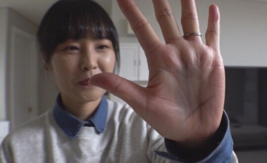 '세상에 이런일이' 흑색피부그림증, 금반지로 몸에 검은 선 그려져 : 네이트 뉴스