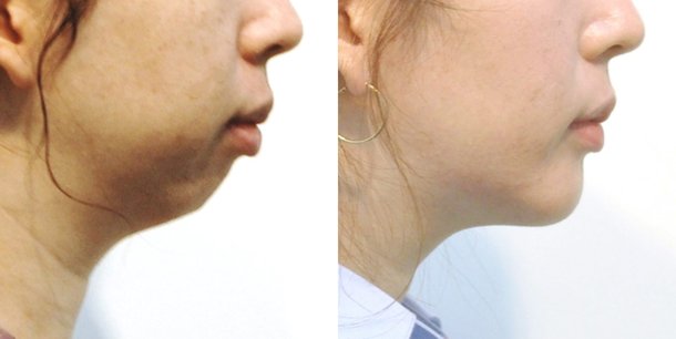 드라마틱한 무턱 수술…얼굴 전체가 바뀐다 : 네이트 뉴스