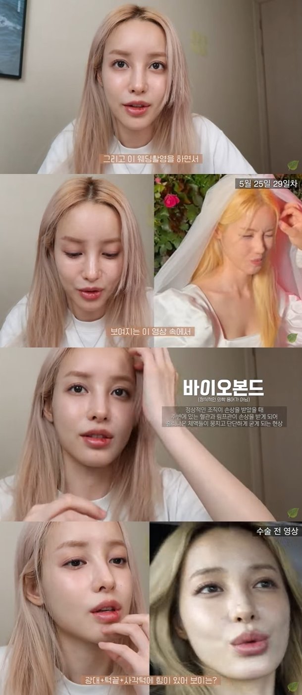유깻잎, 윤곽 수술 후 불편함 