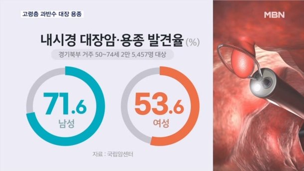 고령층에 쏟아진 대장암 '씨앗' 용종…젊은 층 대장암 발생률도 세계 1위 : 네이트 뉴스