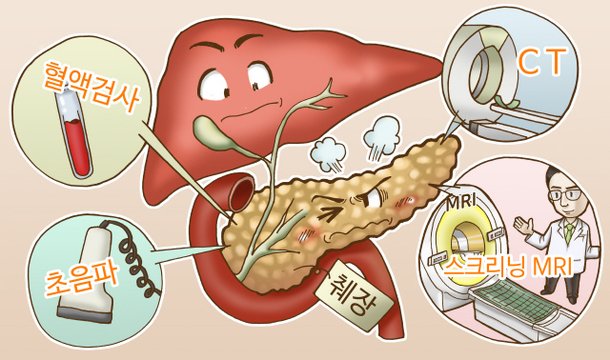 췌장암 두렵다면? 금연·금주·정기검진 필수 : 네이트 뉴스
