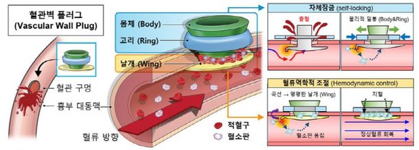 혈류 조절해 스스로 혈관 봉합하는 폐쇄장치 개발…지혈 효율 높여 : 네이트 뉴스