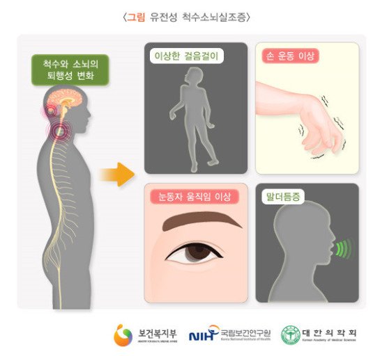 故 노 전 대통령 앓았던 '소뇌위축증'···치료제 없고 진행 늦추는 게 최선 : 네이트 뉴스