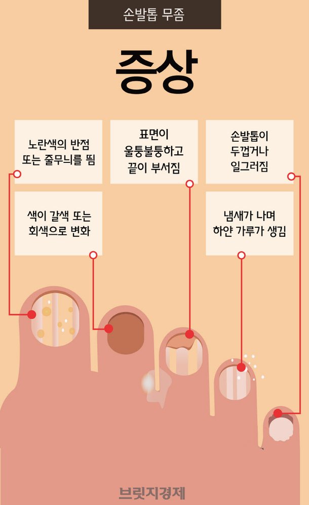 [카드뉴스] 간질간질 무좀 어떻게 잡을까? : 네이트 뉴스