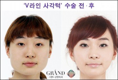 사각턱 수술방법, ‘귀뒤 사각턱수술’ VS ‘V라인 사각턱수술’ : 네이트 뉴스