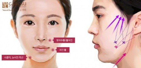 'V라인리프팅'이 동안 만능 해결사? V라인리프팅효과에 대해 알아보자 : 네이트 뉴스