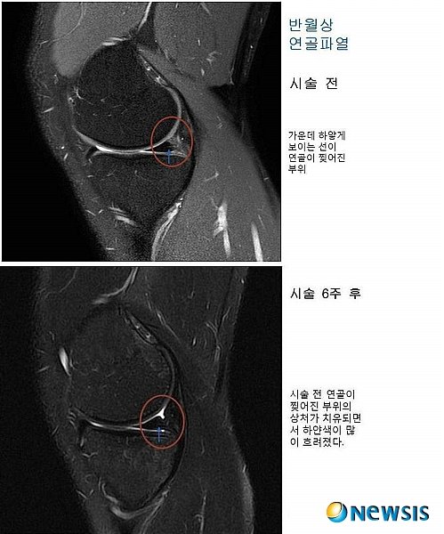칼 대신 주사, 무릎연골파열 '재생세포' 효과확인 : 네이트 뉴스