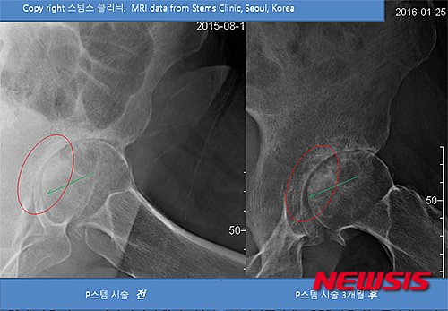 줄기세포 연골재생 치료, 무릎·고관절·턱관절에도 효과 : 네이트 뉴스